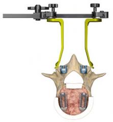 Xia CT (Cortical Trajectory)